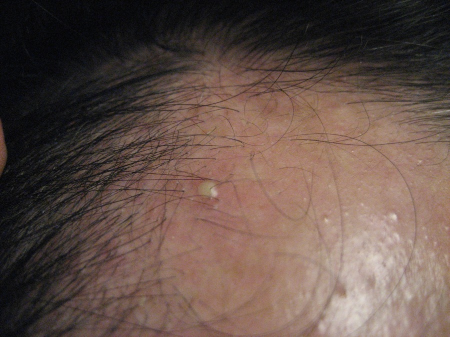 This was by far the most graphic example of the type of pimple I got shortly after I finished applying all 5 vials of AGHC. I continue to get pimple like pustules but nothing as severe as the one pictured. Right temple recession pictured