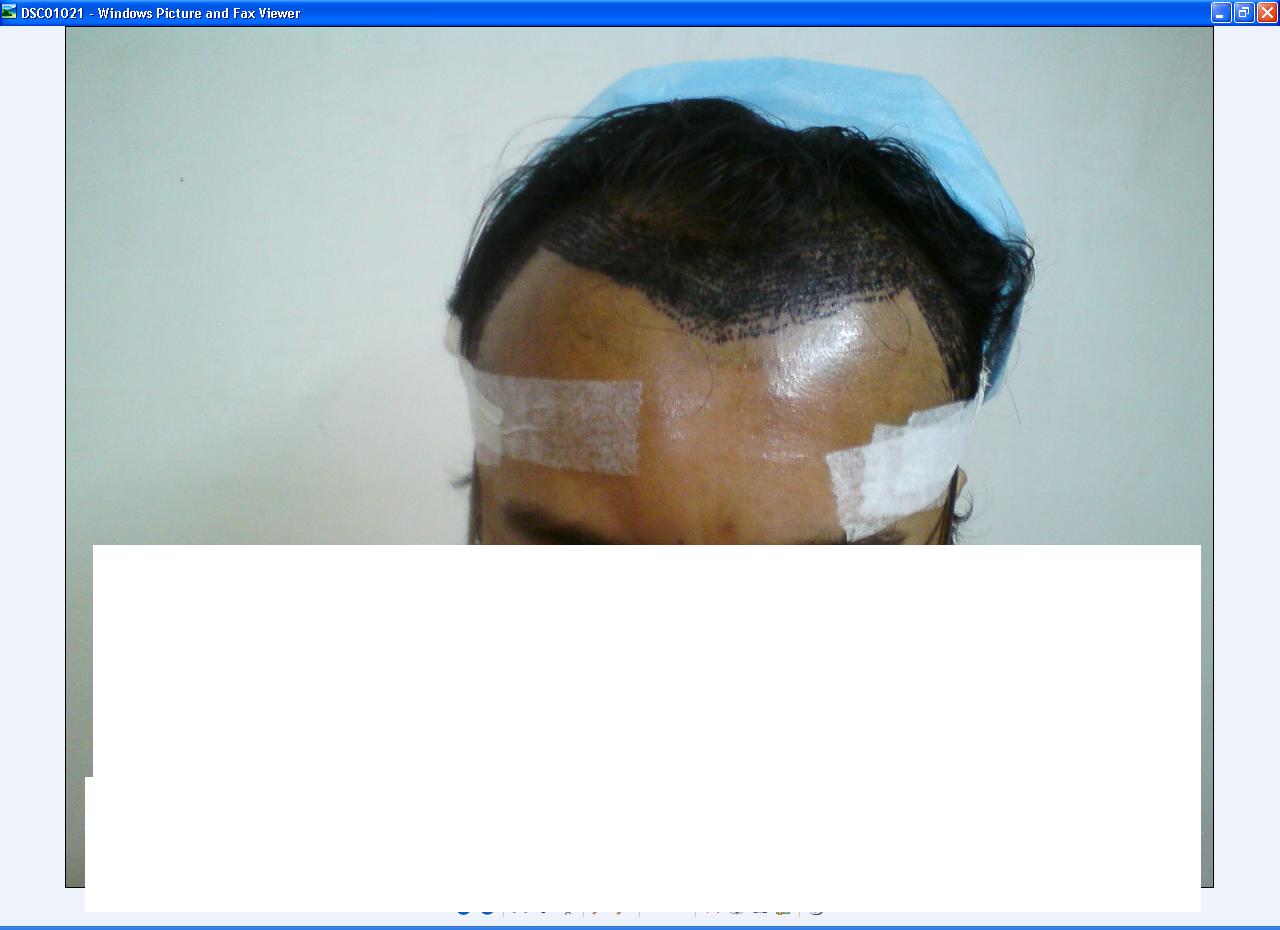 This pic is immediately after surgery