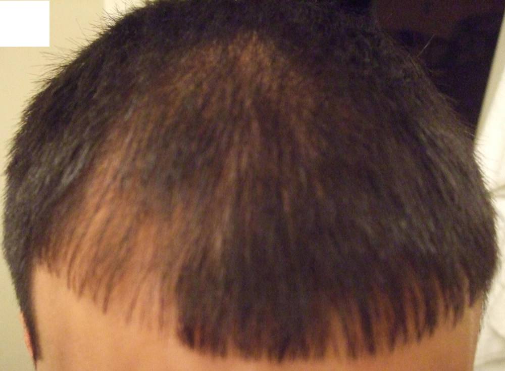 Hair loss on one side of head