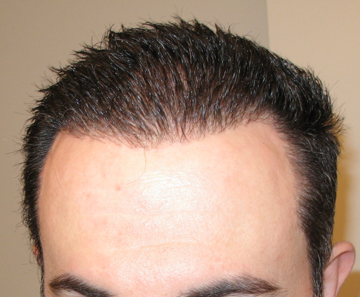 Making progress...  Picture is of frontal hair line with gel in hair.